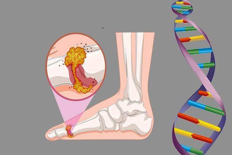 Bệnh gout có di truyền hay không?