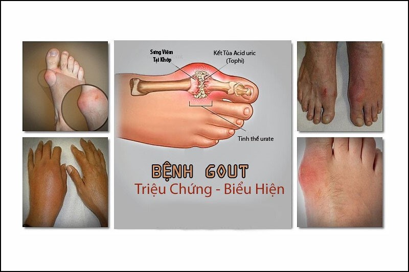 Biểu hiện của bệnh gout mãn tính