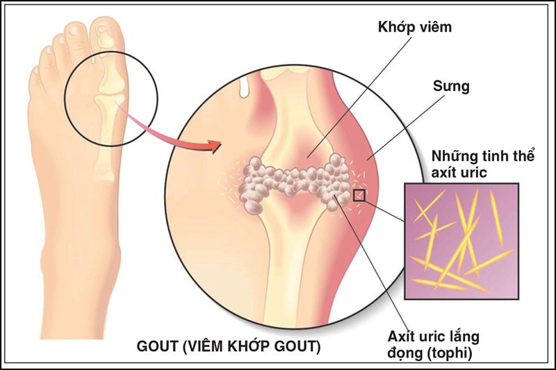 Bệnh gout là hiện tượng đau, sưng đỏ ở các khớp chân, tay