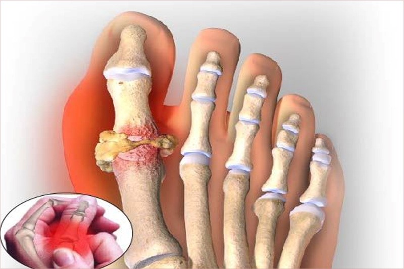 Bệnh gút là một dạng viêm khớp, xảy ra nhiều ở khớp chân và khớp tay