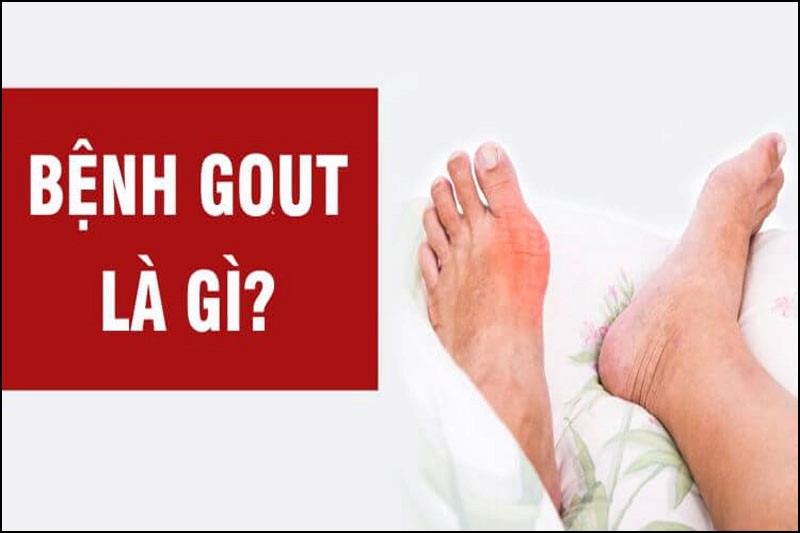 Bệnh gout trở thành căn bệnh khá phổ biến hiện nay