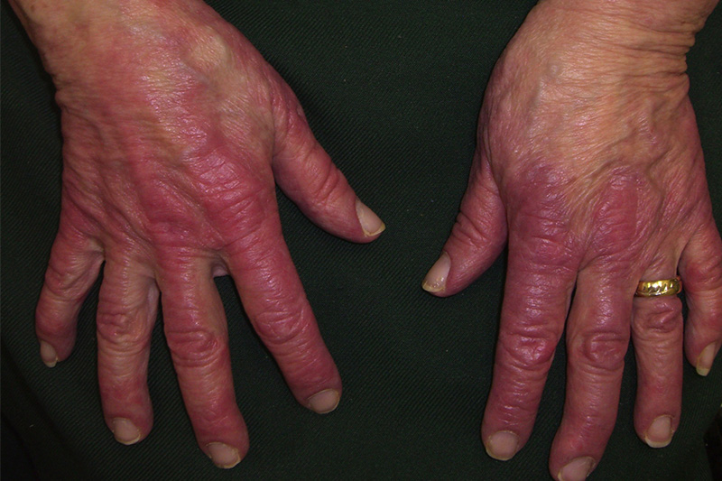 Gout ban đỏ là một bệnh lý về xương khớp rất khó chữa