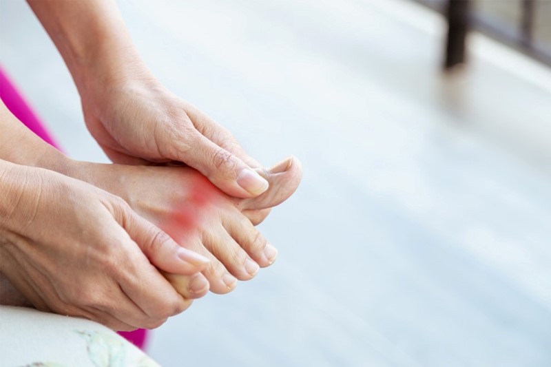 Bị gout chân sưng đau – 3 cách giúp giảm sưng nhanh tại nhà