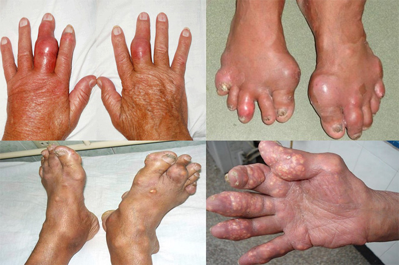 Bệnh gout không được điều trị kịp thời gây nhiều biến chứng nguy hiểm