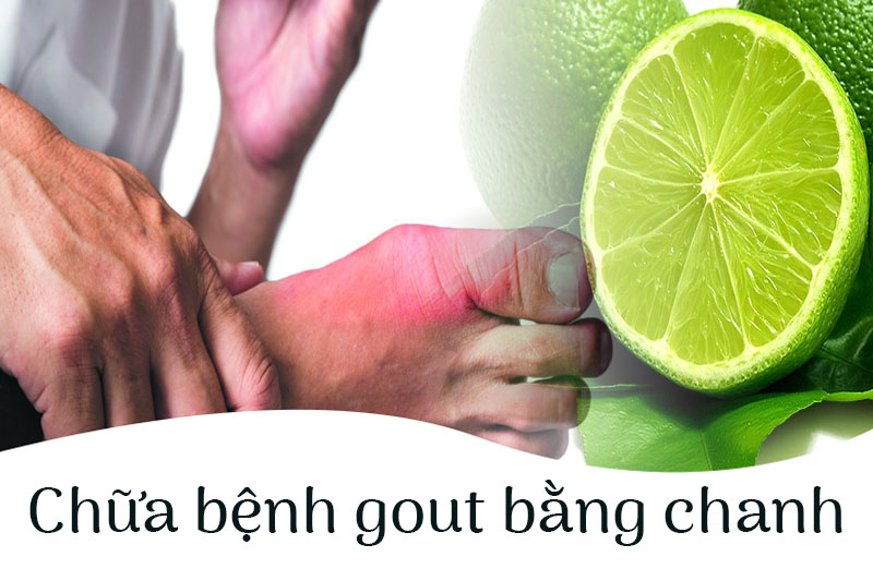 Bạn có biết cách chữa bệnh gout bằng chanh?