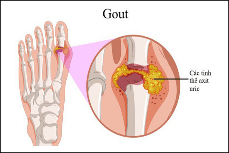 Hiểu rõ nguyên nhân gây ra bệnh gout giúp bạn tránh được tình trạng xấu của bệnh