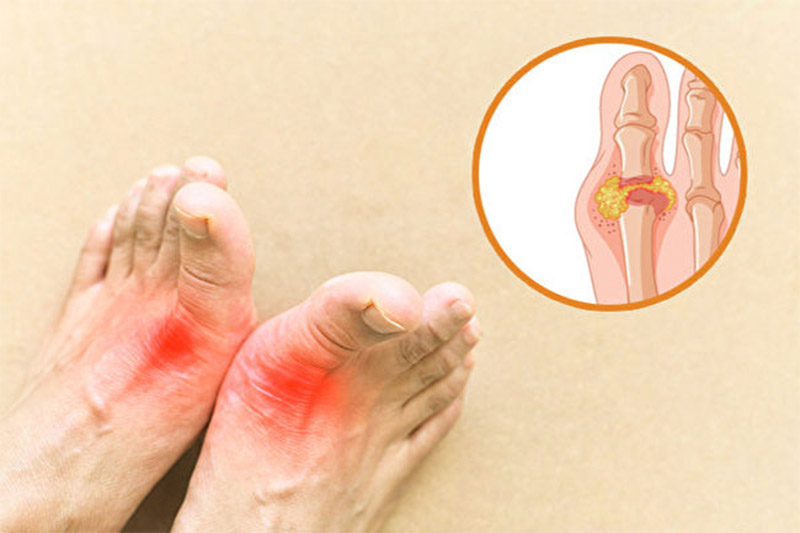 Gout là một dạng viêm khớp phổ biến