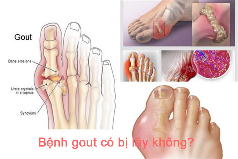 Bệnh gout có bị lây không là thắc mắc của rất nhiều người