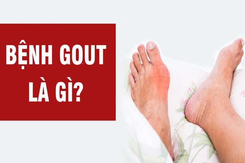 Bệnh gout là gì? Cùng tìm hiểu cách chữa bệnh gout hiệu quả nhất!