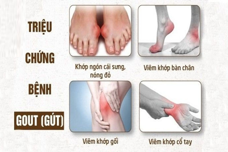 Bạn cần biết và quan tâm đến những triệu chứng bệnh gout là gì