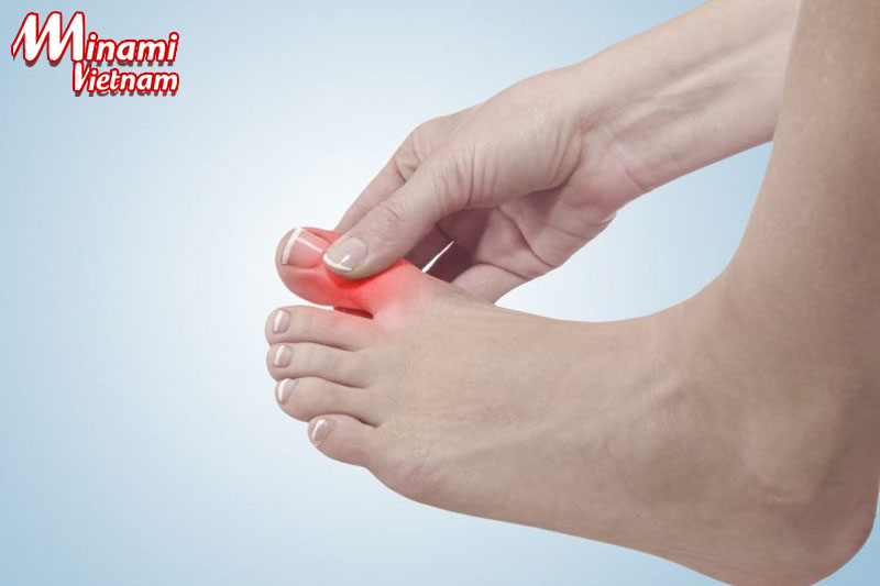 Bệnh gout khiến bạn gặp nhiều khó khăn trong sinh hoạt thường ngày