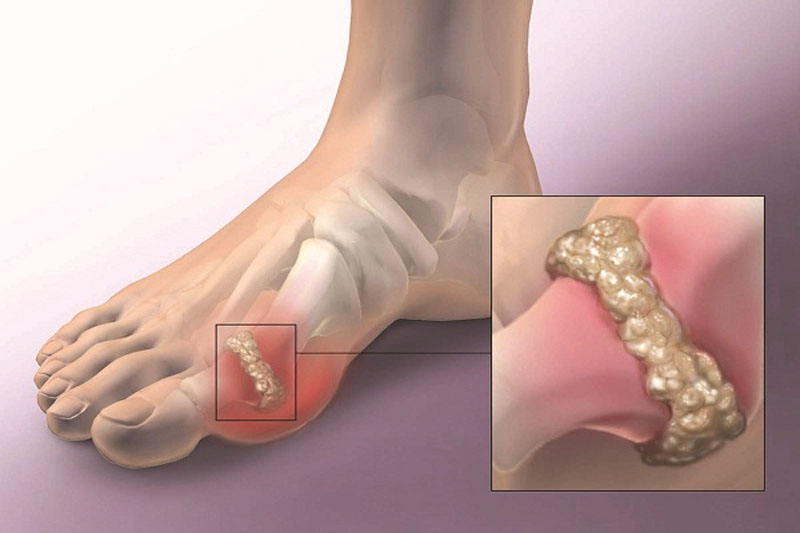 Chữa gout bằng bấm huyệt là một trong những cách cải thiện tình trạng bệnh