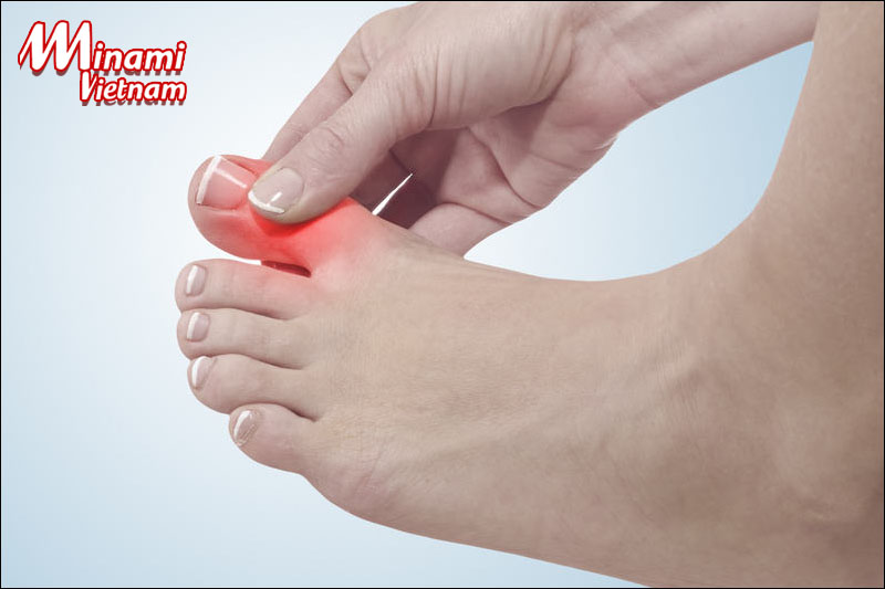 Gout – căn bệnh xương khớp ngày càng trở nên phổ biến