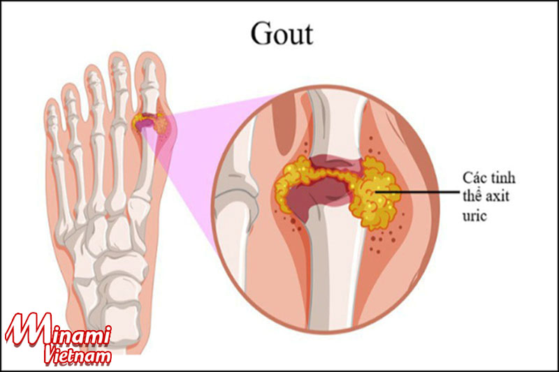 [GIẢI ĐÁP]Gout mãn tính gây nguy hiểm cho sức khỏe thế nào?