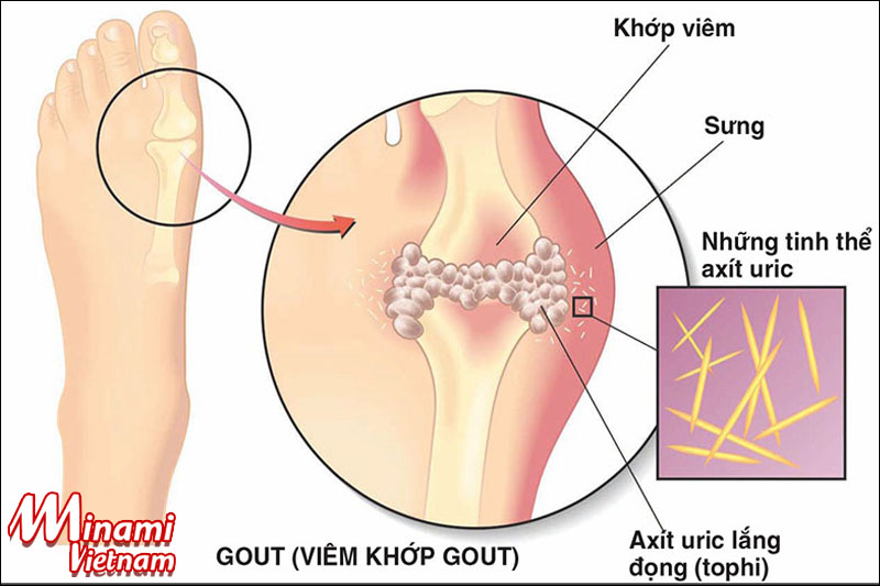 Hàm lượng Purin lớn là nguyên nhân dẫn đến tích tụ Acid Uric gây ra bệnh gout