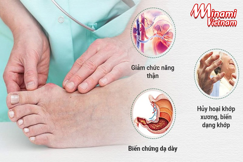 Bạn nên tìm hiểu kĩ càng về bệnh gout