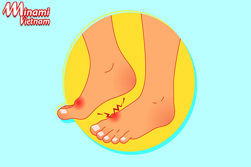 Tìm hiểu bệnh gout và nguyên nhân gây bệnh