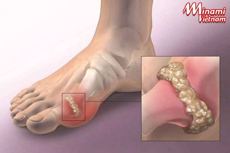 Bệnh gout và nguyên nhân gây bệnh