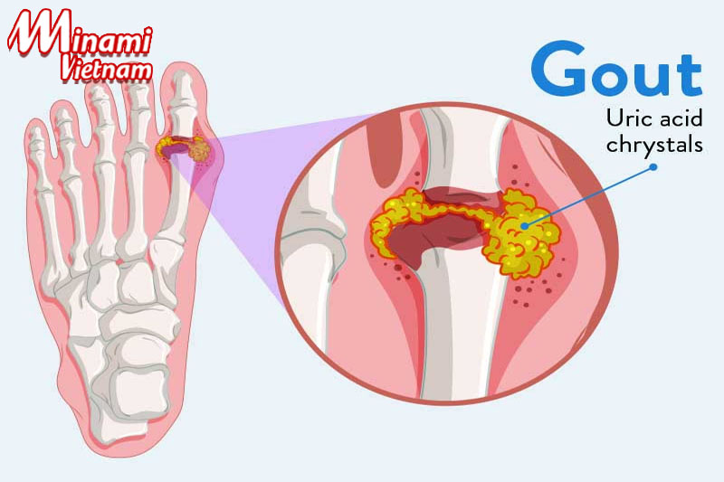 Bị gout ăn măng được không? Giải pháp xoa tan cơn đau gout!