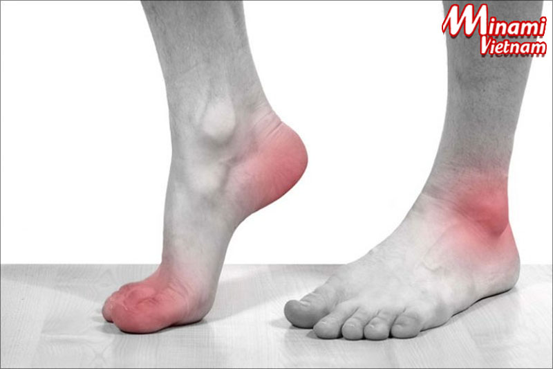 Giảm Axit Uric mới chữa được gout có đúng không?