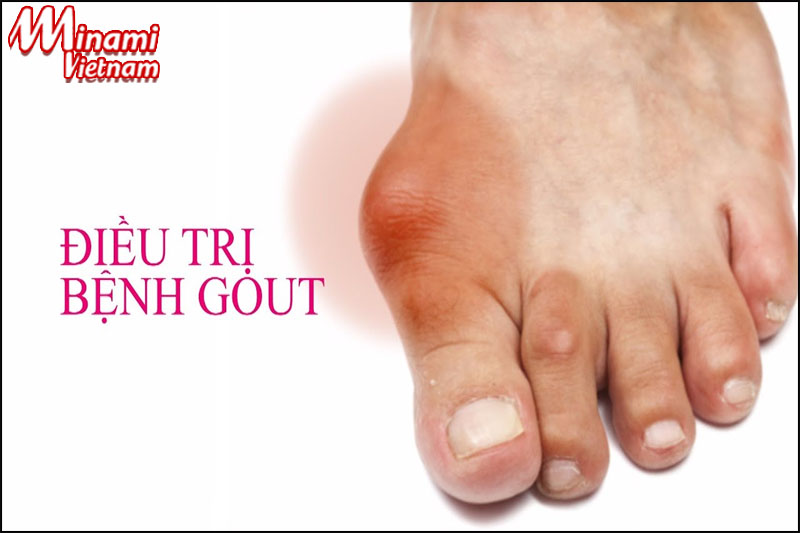 Bệnh gout là căn bệnh thường gặp ở nam giới