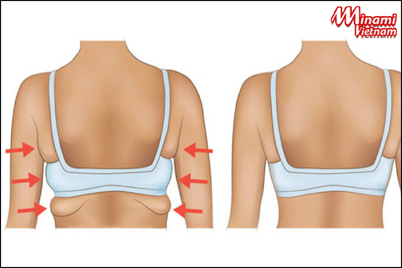 Kích cỡ áo ngực không phù hợp cũng là nguyên nhân gây tích tụ mỡ vùng lưng.