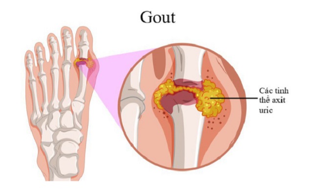 Triệu chứng bệnh gout