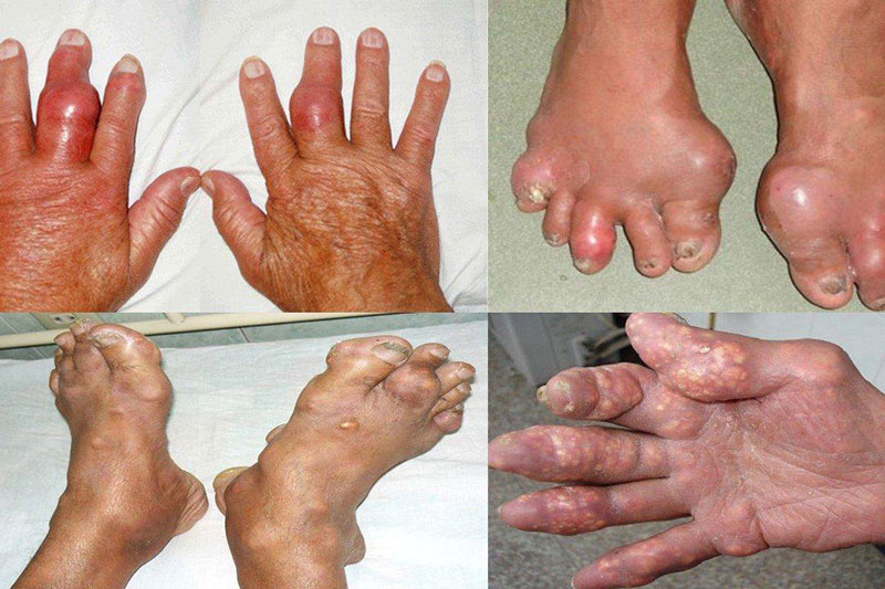 Bệnh gout mãn tính có thể gây ra rất nhiều biến chứng nguy hiểm