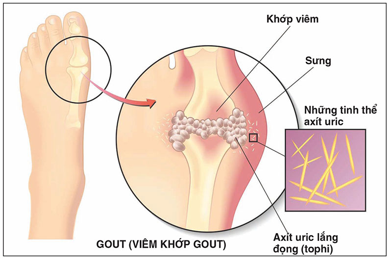 Gout – căn bệnh xương khớp tiềm ẩn nhiều biến chứng nguy hiểm