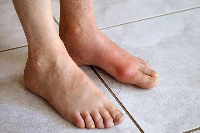 Chữa dứt điểm bệnh gout, tránh ảnh hưởng tới sức khỏe về sau
