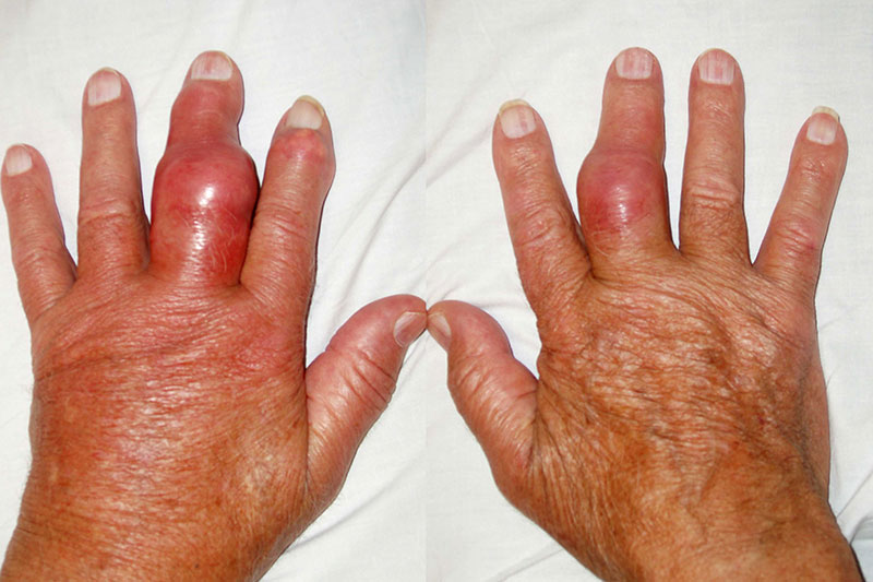 U cục tophi – biến chứng do bệnh gout gây ra cực nguy hiểm