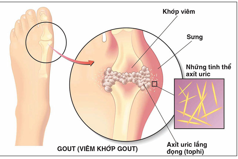  Hàm lượng Purin lớn là nguyên nhân đẫn đến tích tụ Acid Uric gây ra bệnh gout