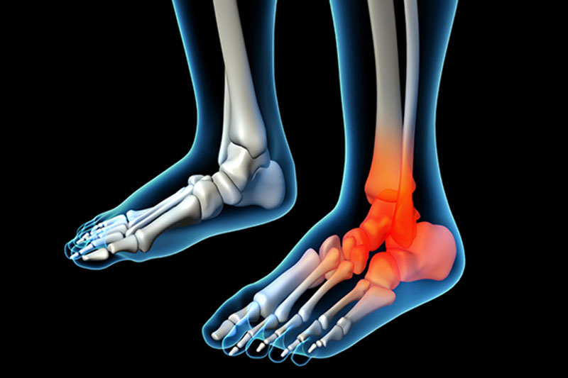 Triệu chứng đau gót chân do bị viêm thường gặp ở người trung niên