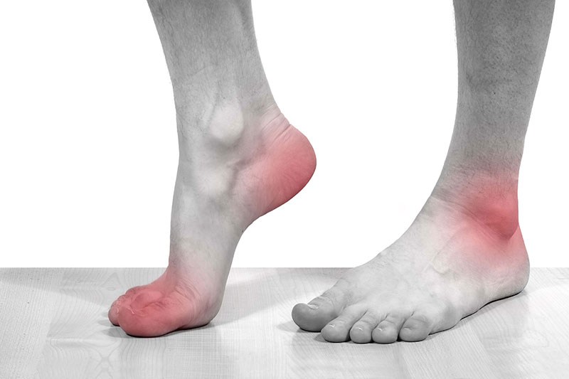Đau gót chân là biểu hiện điển hình của bệnh gout